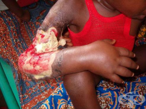 Опасно! Ужасяваща болест върлува в Африка